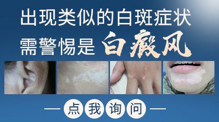 春季白癜风症状